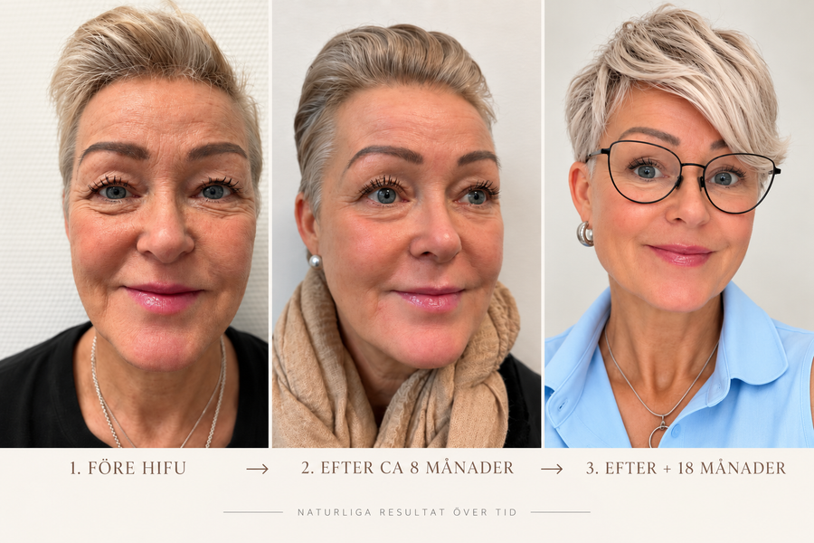 Irenes HIFU-resa i tre steg: före behandling, efter cirka 8 månader och efter drygt 18 månader.